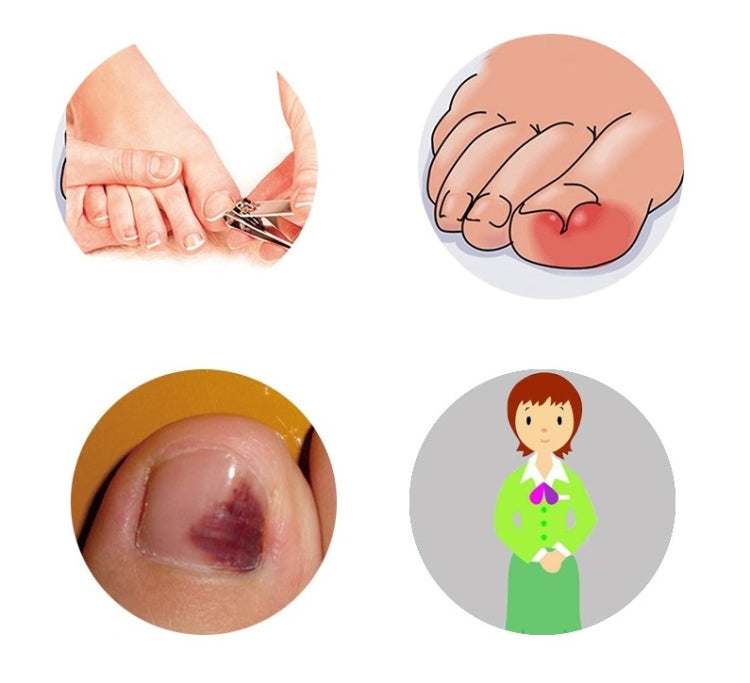 12 in 1 Toenail Orthosis With Ingrown Toenails