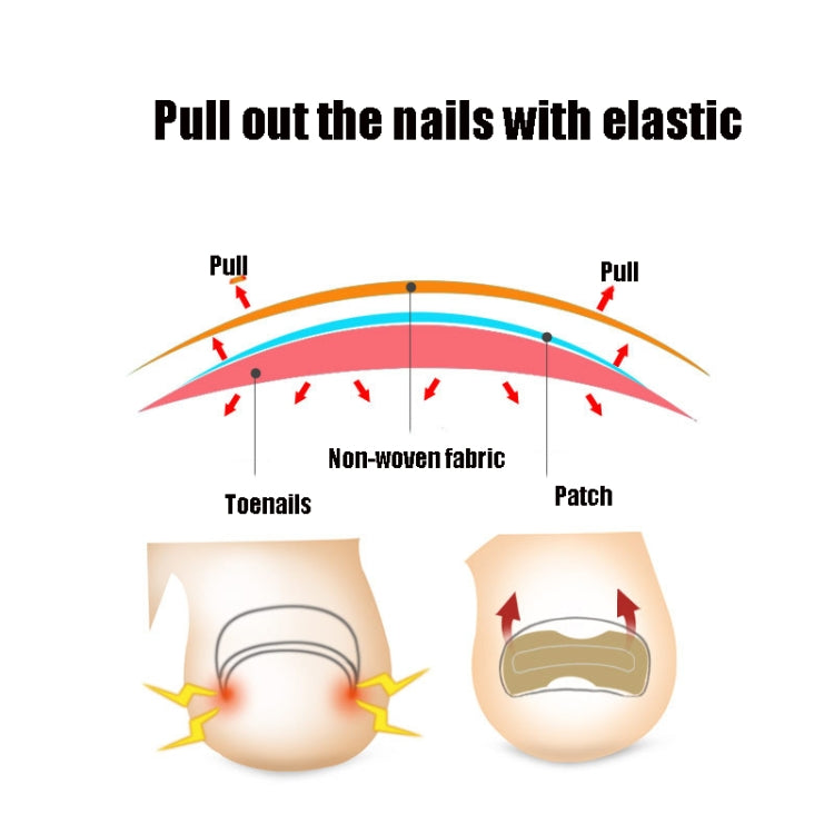 10 PCS Glue-free Orthopedic Nail Stick Toe Nail Groove Inlay Corrector, Transparent Bottom, White Bottom, Blue Bottom