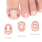 6pcs /Box Ortho Wire Nail Insertion Orthotic Toe Nail Ortho Hooks